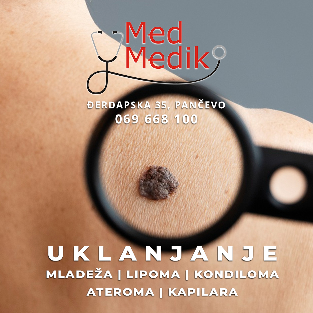 Uklanjanje mladeza - lipoma - ateroma - kapilara - kondiloma - Pancevo - med medik ordinacija